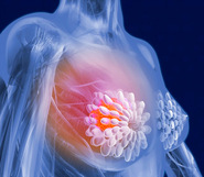 Oncoplastic Breast Surgeon Cardiff
